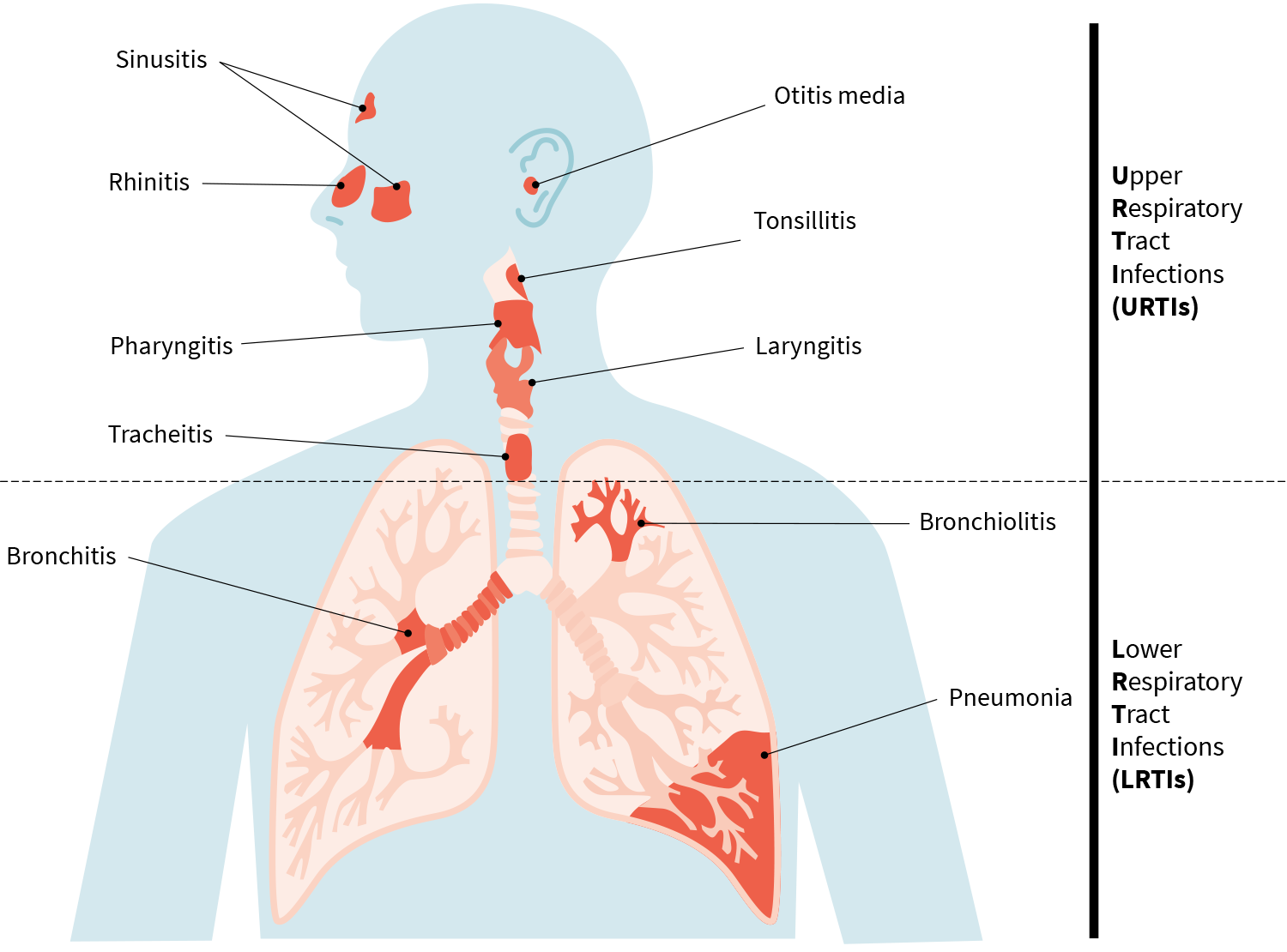 upper-respiratory-infection-symptoms-what-are-the-early-signs-of-upper